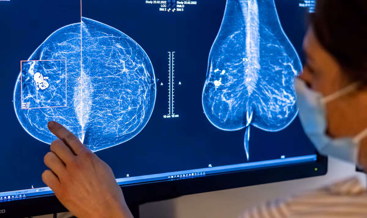 La IA revoluciona la detección temprana del cáncer de mama